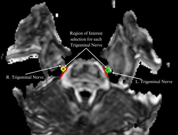 Columbia Neurosurgery’s Reflections on the Facial Pain Patient Journey and Treatment Options
