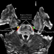 Columbia Neurosurgery’s Reflections on the Facial Pain Patient Journey and Treatment Options